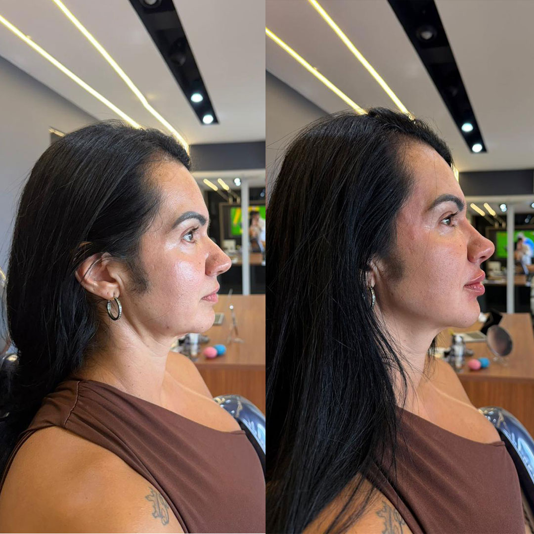 Caso 1 - Antes e depois